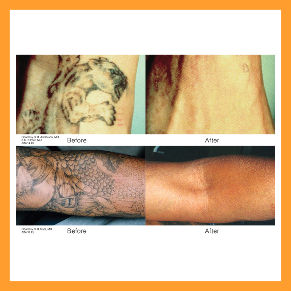 Revlite Laser | Melasma, Dark Underarms, Tattoo Removal,Skin Lightening