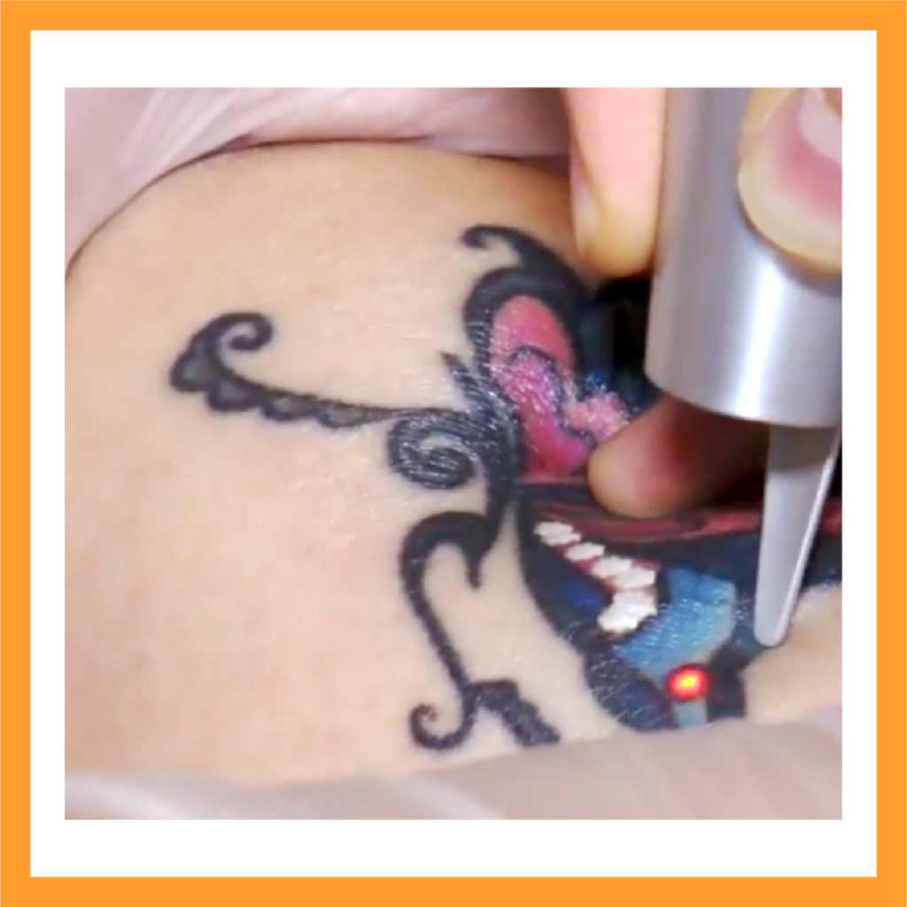 Revlite Laser | Melasma, Dark Underarms, Tattoo Removal,Skin Lightening Revlite Laser | Melasma, Dark Underarms, Tattoo Removal,Skin Lightening